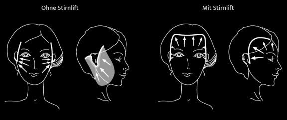 Grafik Facelift, Dr. Deb, Central Aesthetics, Plastische Chirurgie & Schönheitschirurgie in Frankfurt