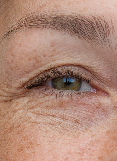 Unterlidstraffung, Dr. Deb, Central Aesthetics, Plastische Chirurgie & Schönheitschirurgie in Frankfurt